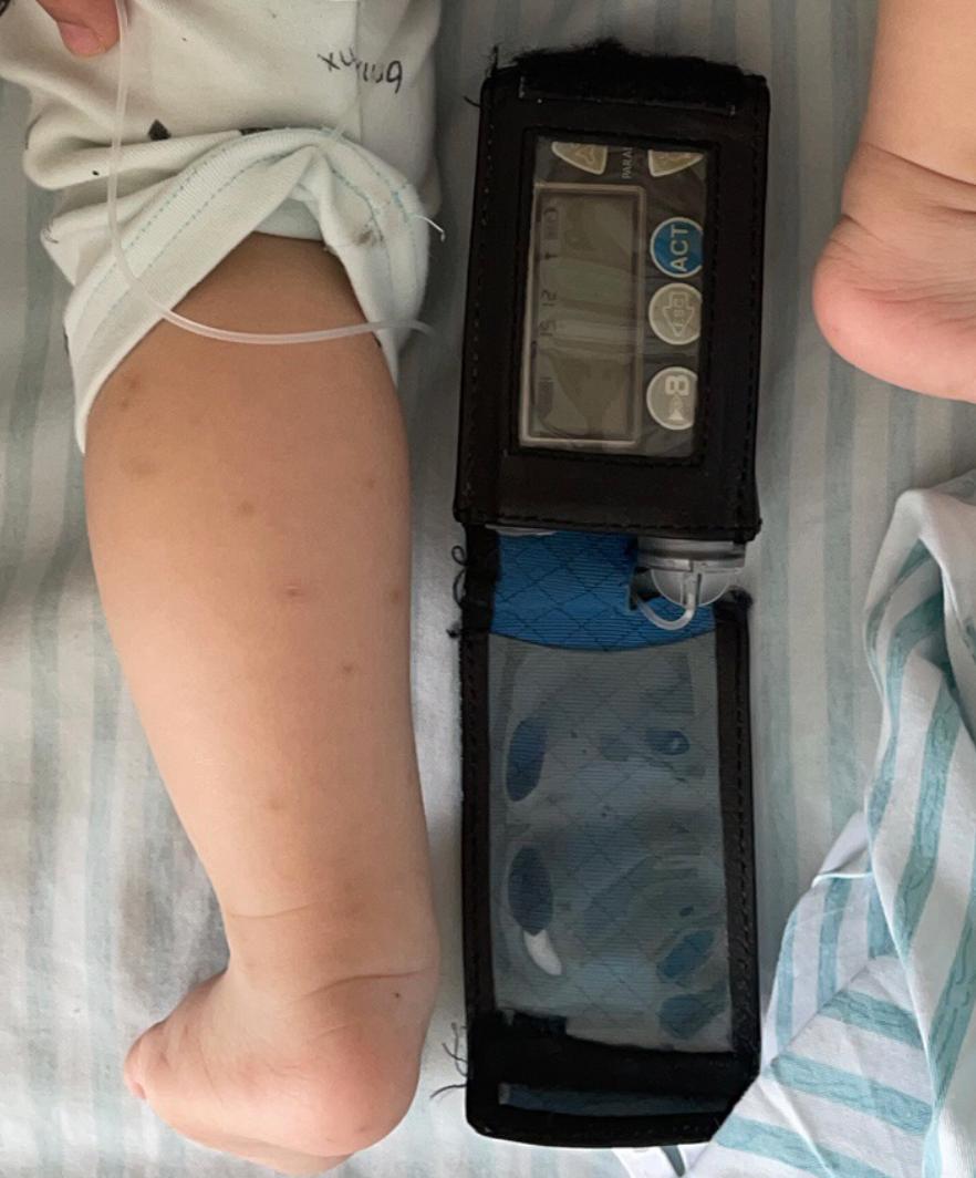 最新胰岛素泵使用指南及步骤详解