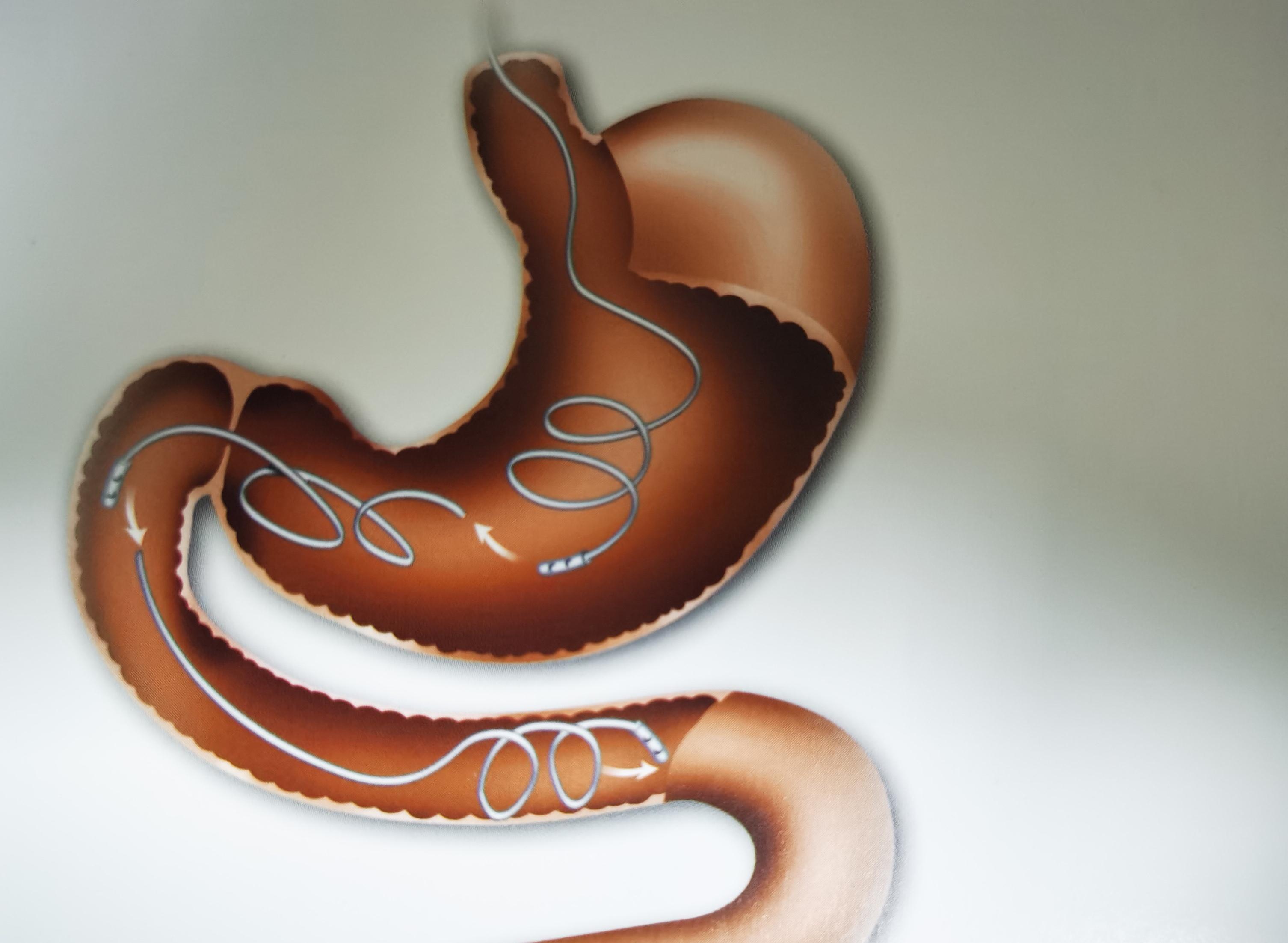 最新鼻肠管护理PPT深度解读与指南