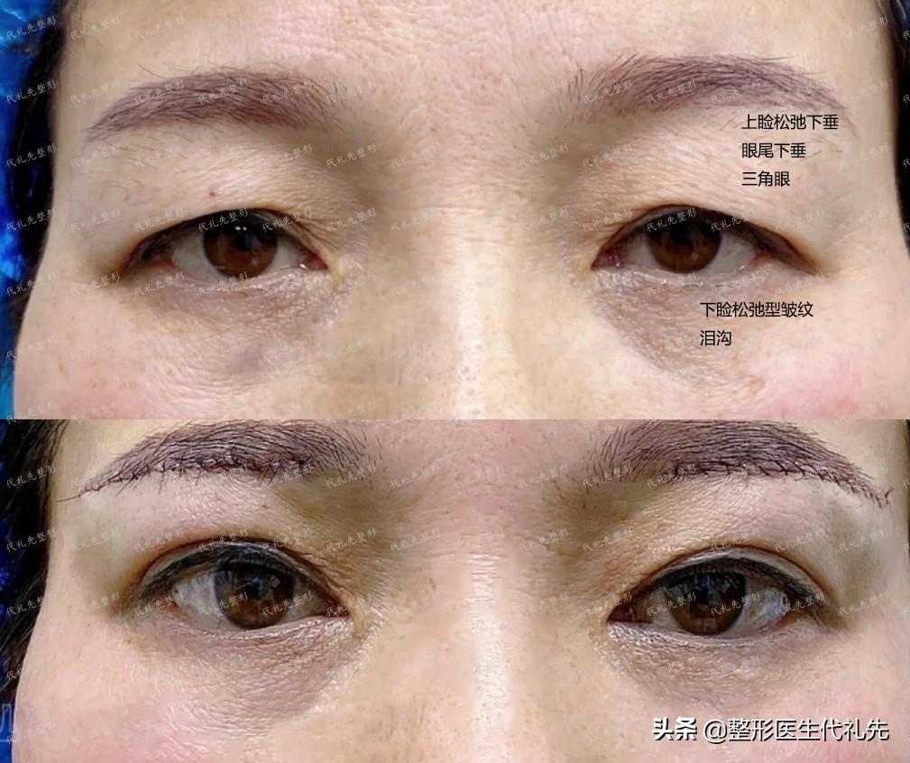 最新双眼皮手术技术，重塑美丽，焕发新生活