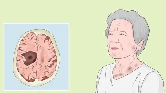 神经纤维瘤病最新进展,全面步骤指南与最新治疗突破探索