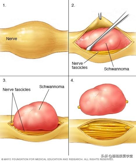神经纤维瘤病最新进展,全面步骤指南与最新治疗突破探索