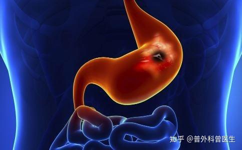 胃溃疡最新状况,病痛中的崛起与变化的力量